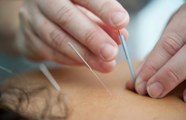 Acupuncture for Low Back Pain