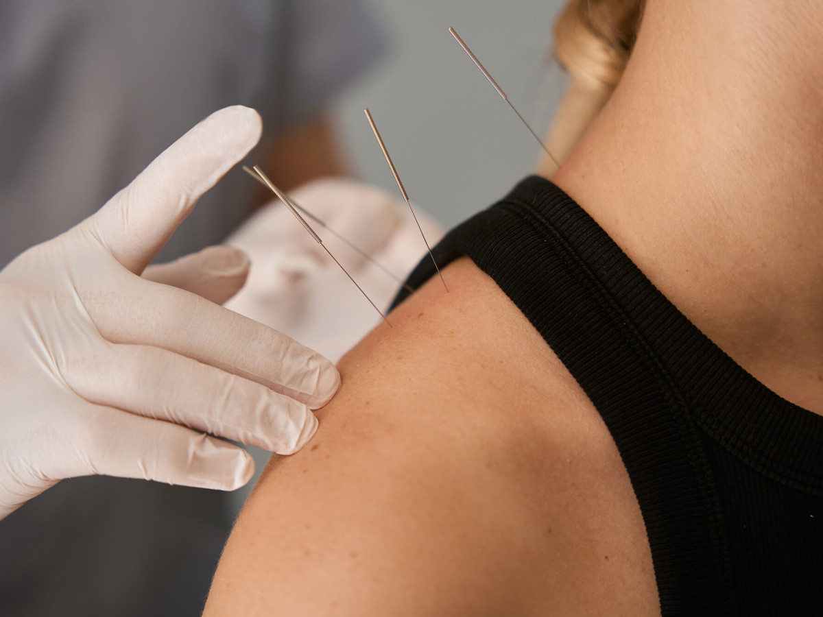 Acupuncture