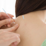 Acupuncture